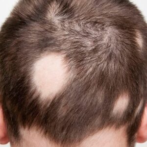 Пересадка волос при алопеции
