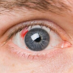 IMO-да диабеттік ретинопатияны емдеу