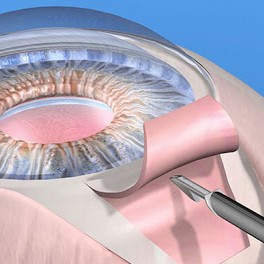 Хирургия глаукомы