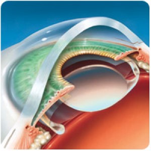 хірургія катаракти у Вені Віді