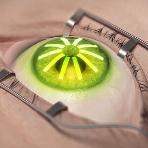 Crosslinking of the cornea