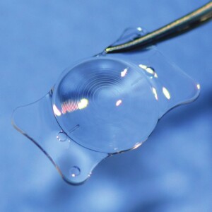 Cataract treatment - trifocal lenses
