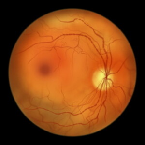 Diagnosis: fundus ophthalmoscopy