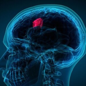 San Rafael: brain tumor treatment
