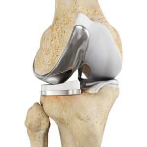 full or partial joint replacement