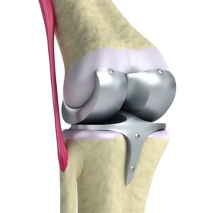 Joint replacement in Galeazzi, Italy