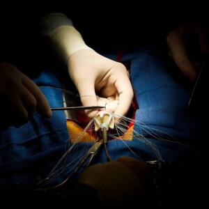 Клиника Аполло: операция на сердце
