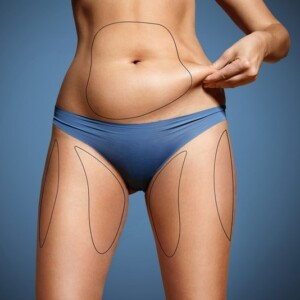 Istanbul Aesthetic: Liposuction