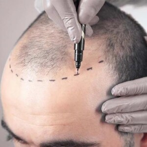 Трансплантація волосся в Estetik International