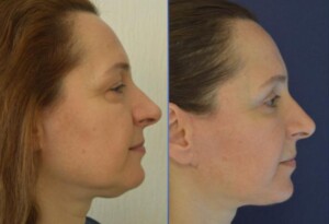 facelift in Turkey before and after 