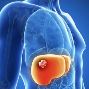 liver cancer treatment - University Hospital of Navarra