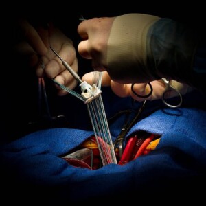 Как проводят операцию по замене клапана сердца