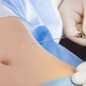 Liposuction in Turkey, indications