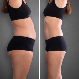Tummy tuck in Turkey: before and after