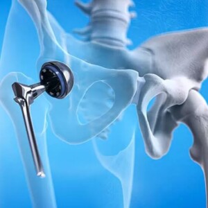 Endoprosthesis of joints: shoulder, elbow, hip, knee, interphalangeal