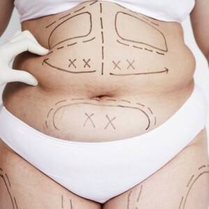 Liposuction at JK Clinic, Korea