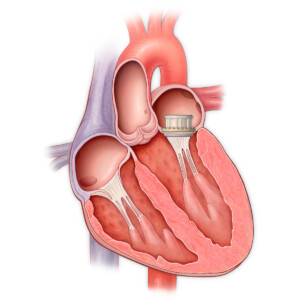 mitral valve repair and replacement in Fortis