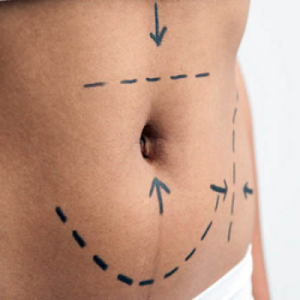 Who should have abdominoplasty