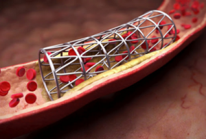 What is coronary stenting