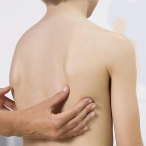 Scoliosis in a child - surgery