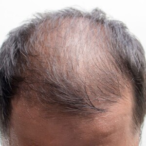 When is the hair transplantation needed