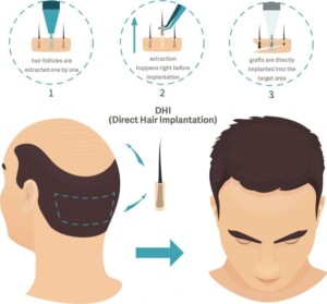 Как проводится пересадка волос методом DHI
