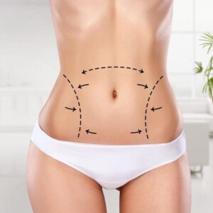 Liposuction in the Estetika medical center