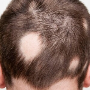 Turkeyana Clinic: hair loss treatment