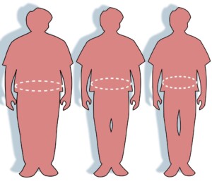Желудочное шунтирование в Турции: лечение ожирения