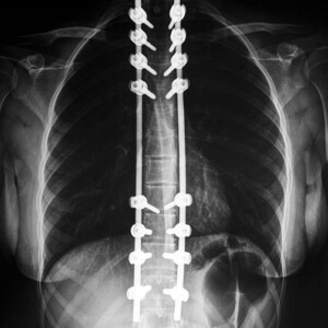 Surgical treatment of scoliosis in Turkey