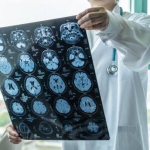 Прогноз при лечении опухолей головного мозга в Турции