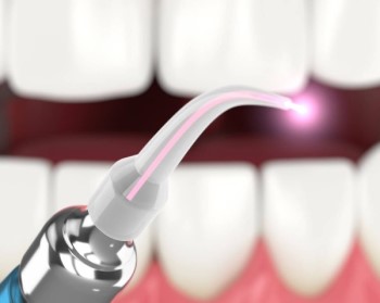 Лазерна імплантація зубів у Туреччині