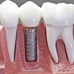 Dental implantation and prosthetics in Turkey