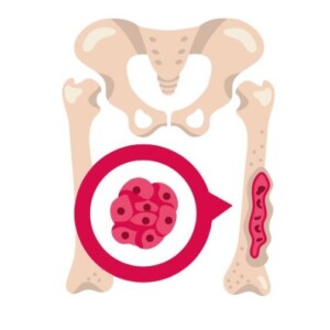 трансплантація кісткового мозку