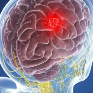 Протонная терапия: лечение опухоли мозга