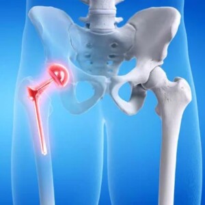 Replacement of the hip joint