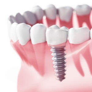 зубні імпланти