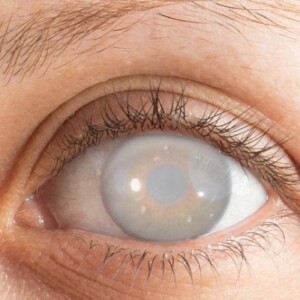 cataract treatment