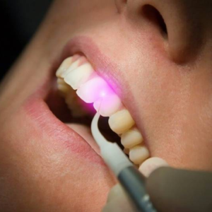 Laser dental treatment