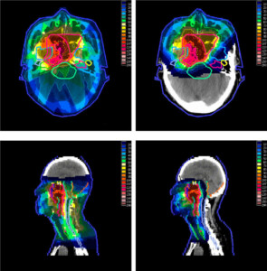 How is proton beam therapy different from conventional radiotherapy