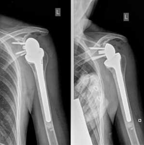 Vitas Clinic Department of Orthopedics: Shoulder Joint Replacement
