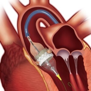 кардиохирургия в клиниках Витас