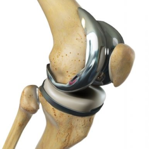 joint replacement in Helios Krefeld