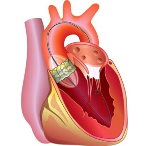 transcatheter aortic valve implantation (TAVI)