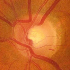 Відкритокутова глаукома