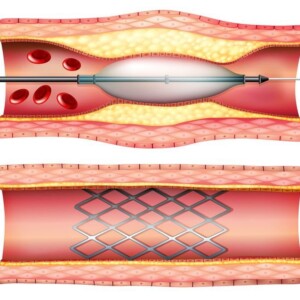methods of coronary artery bypass grafting in Israel