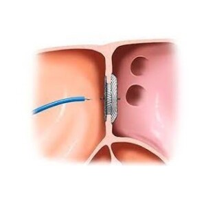 endovascular closure of a ventricular septal defect