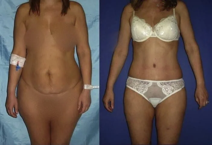 Belly liposuction
