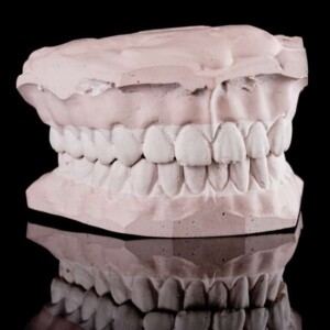 Етапи протезування зубів у Туреччині: Відбиток