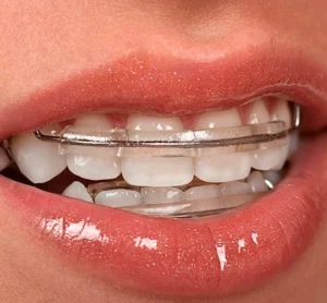 Teeth retainers in Turkey